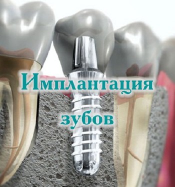 Имплантация зубов (2014)