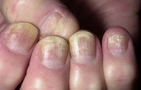 Лечение грибковых заболеваний ног и ногтей | Блоги